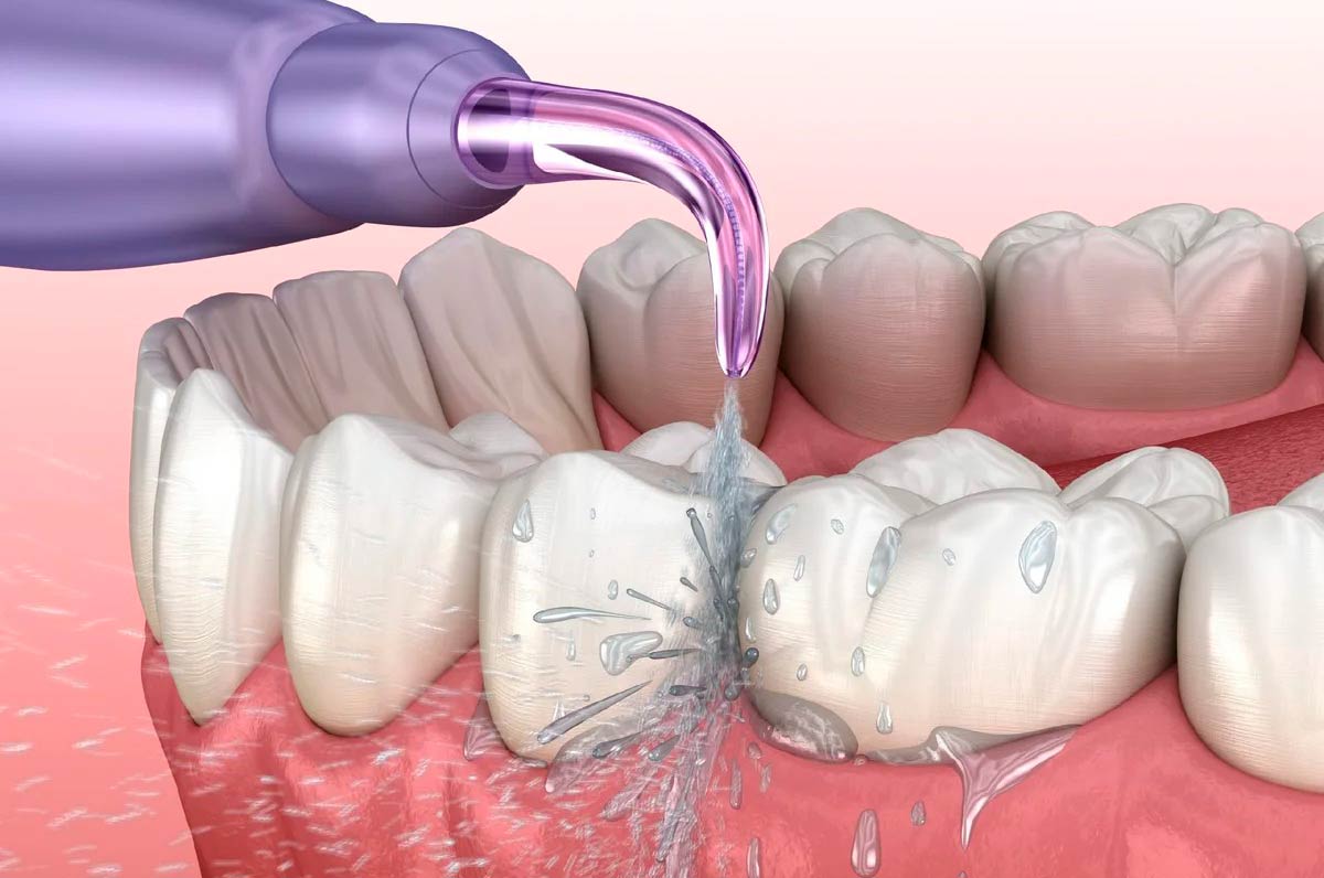 Как пользоваться ирригатором правильно — ТОП 10 советов